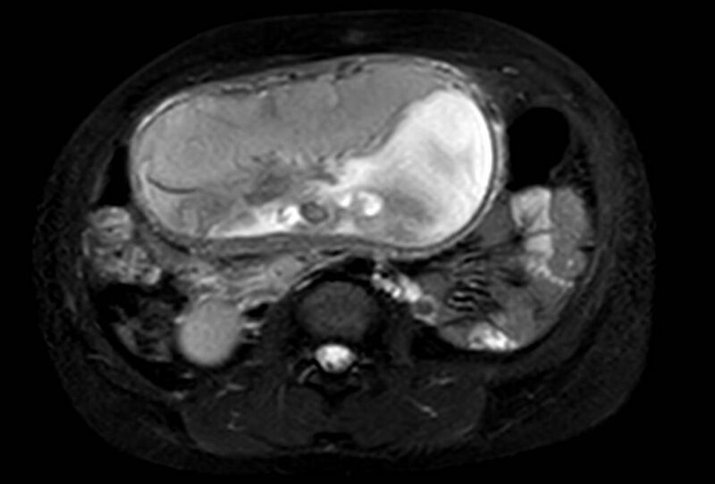File:Appendicitis in gravida (MRI) (Radiopaedia 89433-106395 Axial T2 SPAIR 37).jpg
