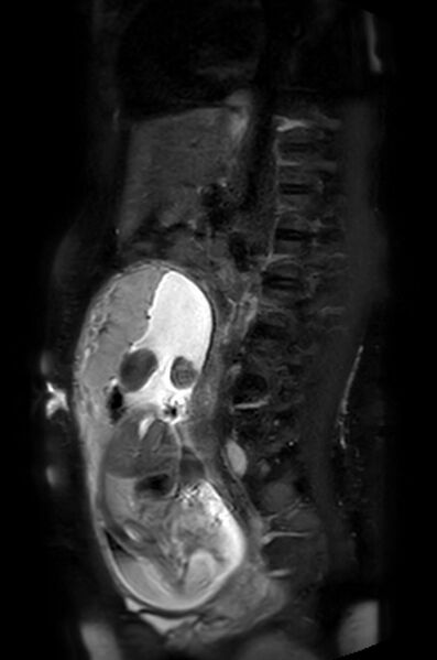 File:Appendicitis in gravida (MRI) (Radiopaedia 89433-106395 Sagittal T2 SPAIR 27).jpg