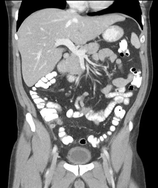 File:Appendicitis with cecal bar sign (Radiopaedia 31878-32830 A 28).jpg