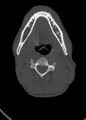 Arrow injury to the head (Radiopaedia 75266-86388 Axial bone window 19).jpg