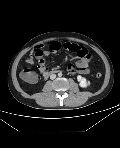 File:Arterial occlusive mesenteric ischemia (Radiopaedia 84641-100054 A 59).jpg