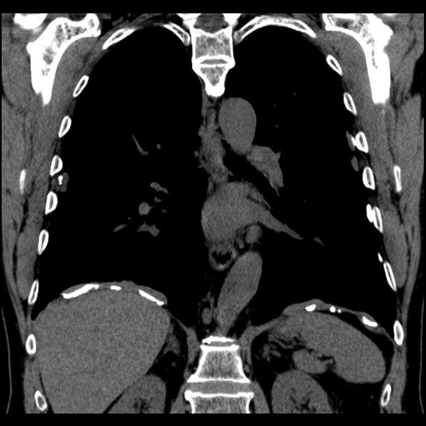 Asbestos-related pleural plaques (Radiopaedia 39069-41255 Coronal non-contrast 33).jpg