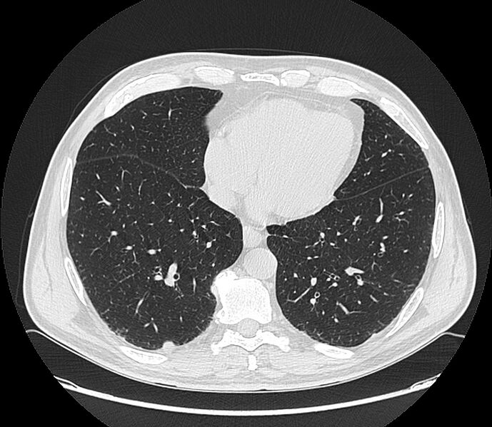 File:Asbestos pleural placques (Radiopaedia 57905-64872 Axial lung window 170).jpg