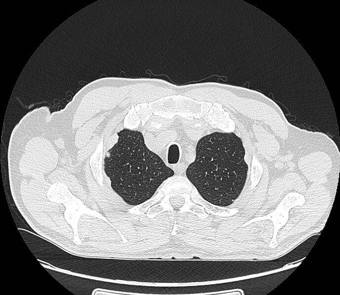 File:Asbestos pleural placques (Radiopaedia 57905-64872 Axial lung window 42).jpg