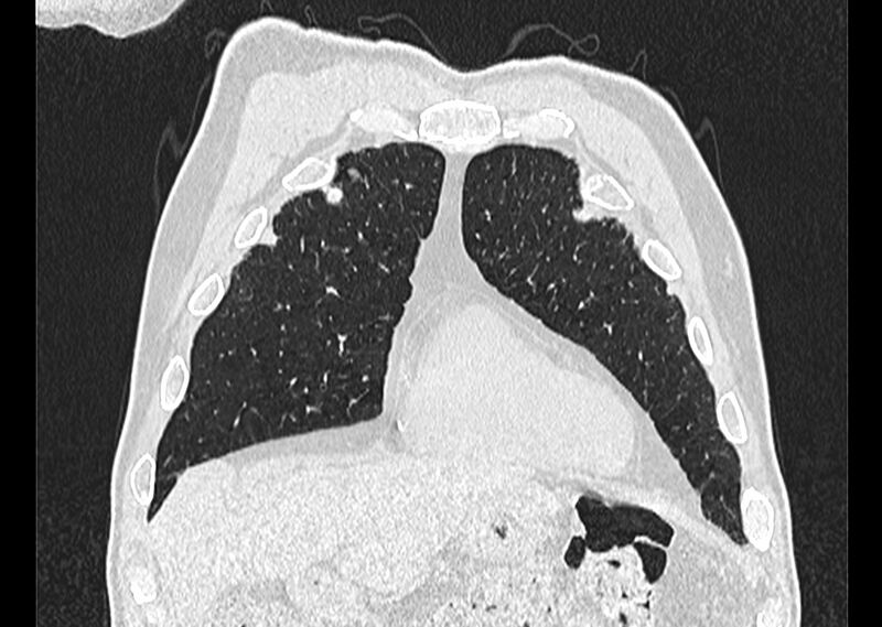 File:Asbestos pleural placques (Radiopaedia 57905-64872 Coronal lung window 47).jpg