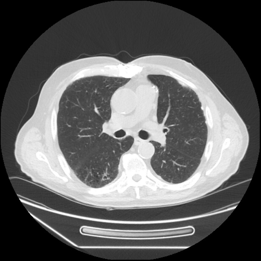 Asbestosis complicated by lung cancer (Radiopaedia 45834-50116 Axial lung window 31).jpg