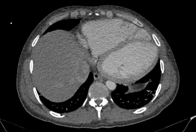 File:Ascending aortic aneurysm (Radiopaedia 86279-102297 C 52).jpg