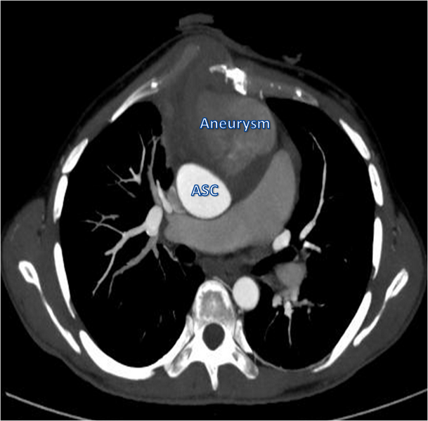 File:Ascending aortic pseudoaneurysm (Radiopaedia 28638-28911 A 1).png