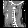 Atlanto-occipital dislocation (Radiopaedia 44648-48412 A 8).jpg