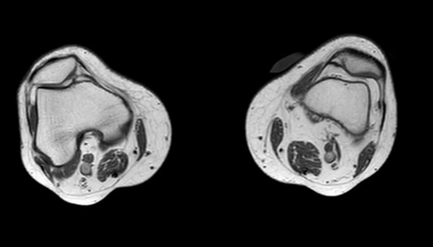 Atypical lipomatous tumor - thigh (Radiopaedia 68975-78734 Axial T1 13).jpg