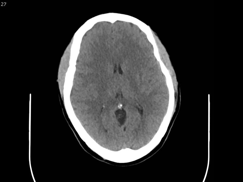File:Atypical meningioma - intraosseous (Radiopaedia 64915-73867 A 27).jpg