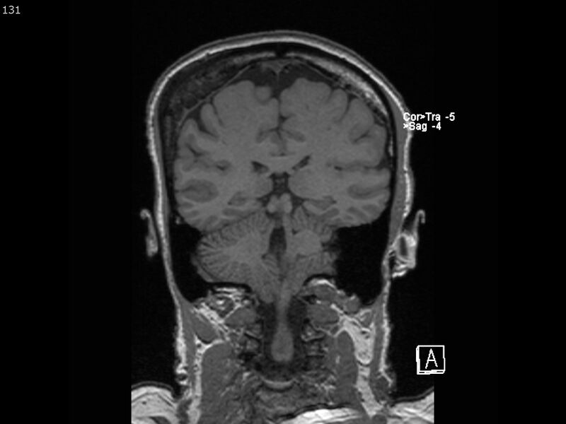 File:Atypical meningioma - intraosseous (Radiopaedia 64915-74572 Coronal T1 131).jpg