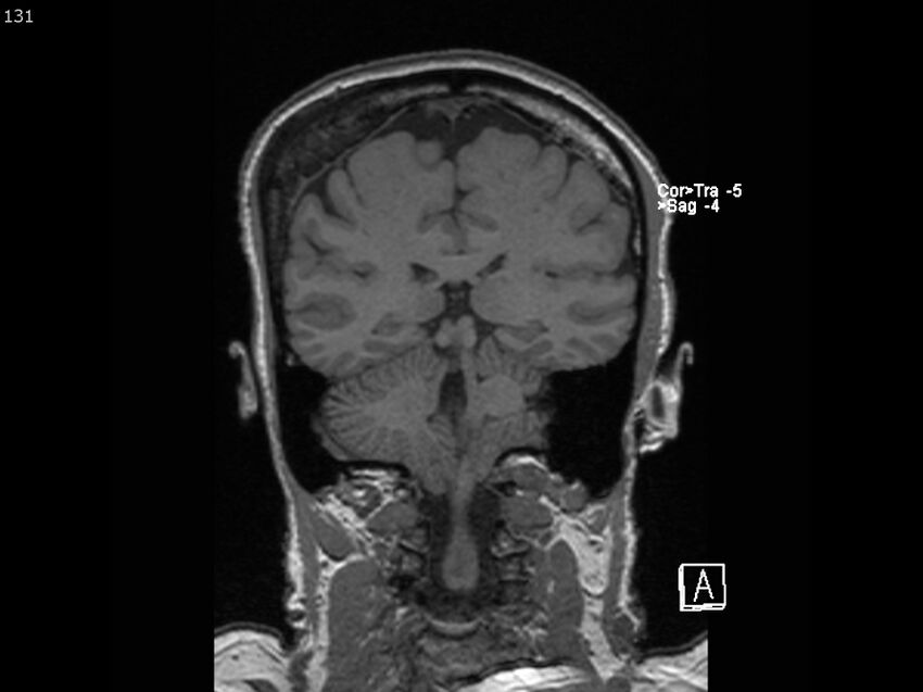 Atypical meningioma - intraosseous (Radiopaedia 64915-74572 Coronal T1 131).jpg