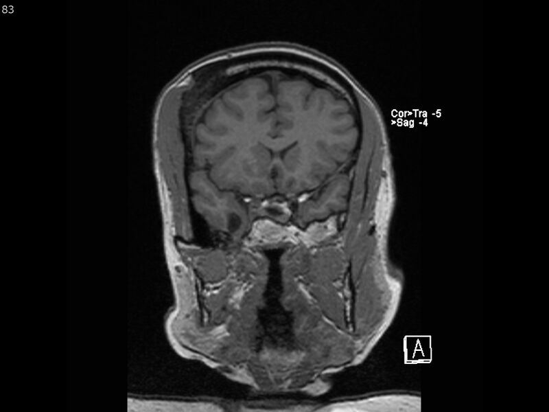 File:Atypical meningioma - intraosseous (Radiopaedia 64915-74572 Coronal T1 83).jpg