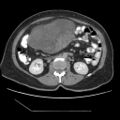 Atypical retroperitoneal lymphocoeles with large leiomyoma of uterus (Radiopaedia 32084-33024 A 19).jpg