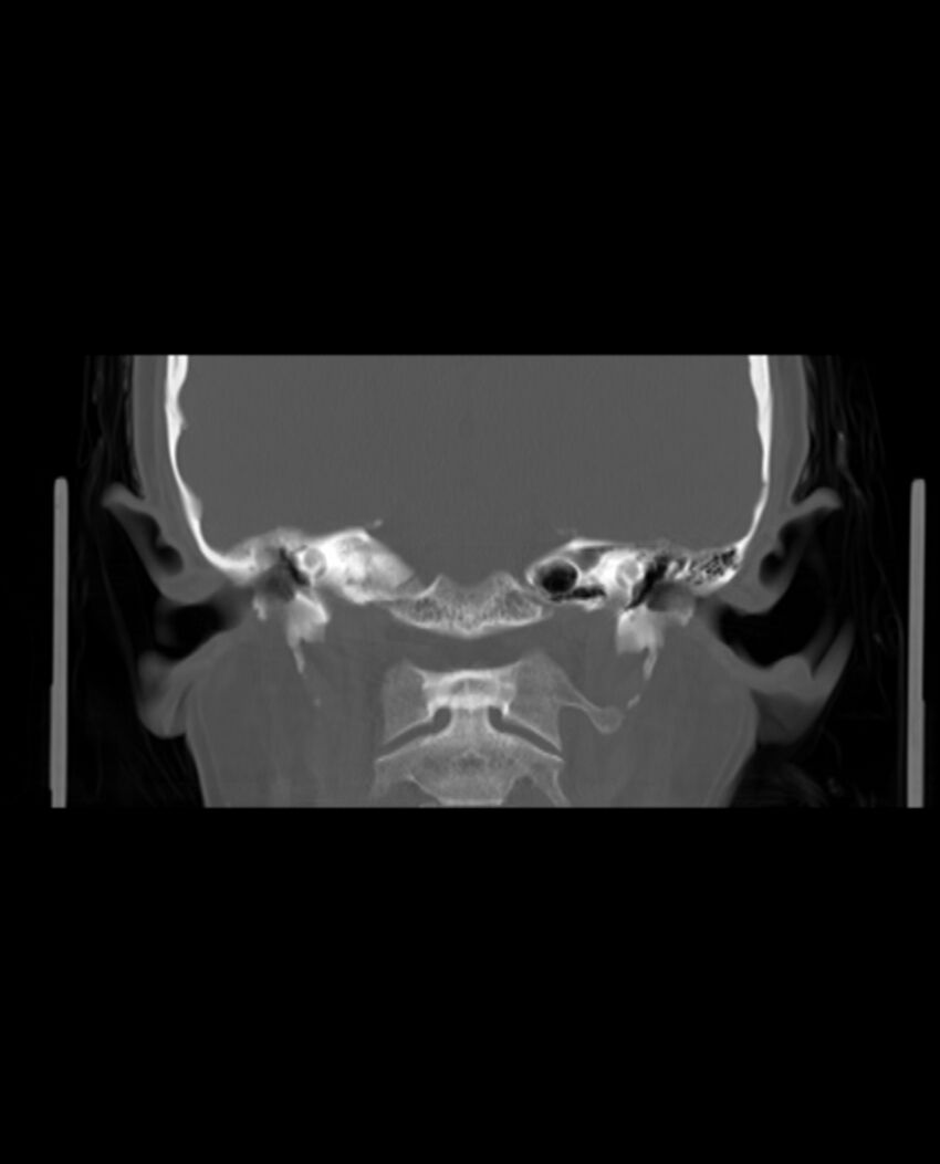 Automastoidectomy with labyrinthine fistula (Radiopaedia 84143-99411 Coronal non-contrast 91).jpg