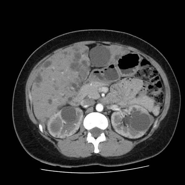 File:Autosomal dominant polycystic kidney disease (Radiopaedia 23061-23093 B 25).jpg