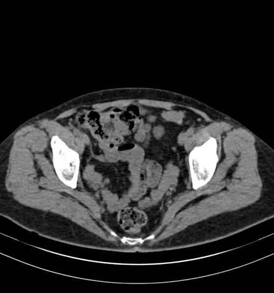 File:Autosomal dominant polycystic kidney disease (Radiopaedia 41918-44922 Axial non-contrast 32).jpg