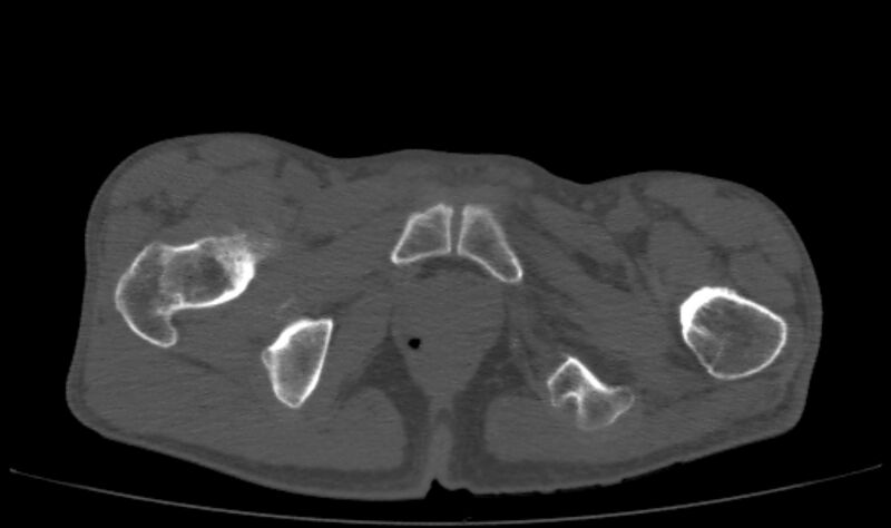 File:Avascular necrosis of the left hip (Radiopaedia 75068-86125 Axial bone window 86).jpg