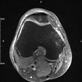 Avulsion fracture of the fibular head (Radiopaedia 74804-85808 Axial PD fat sat 14).jpg