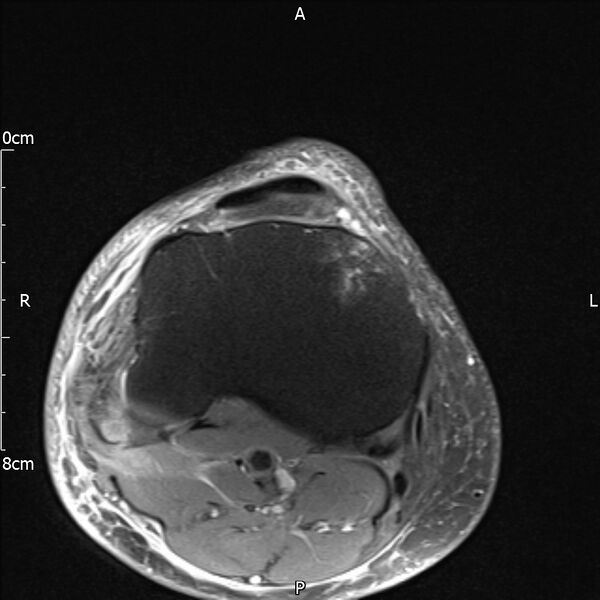 File:Avulsion fracture of the fibular head (Radiopaedia 74804-85808 Axial PD fat sat 29).jpg