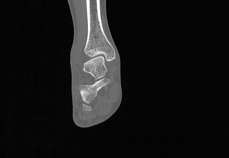 File:Avulsion fractures of talus and calcaneus (Radiopaedia 48277-53155 Coronal bone window 54).jpg