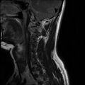 Axis fracture - MRI (Radiopaedia 71925-82375 Sagittal T2 8).jpg