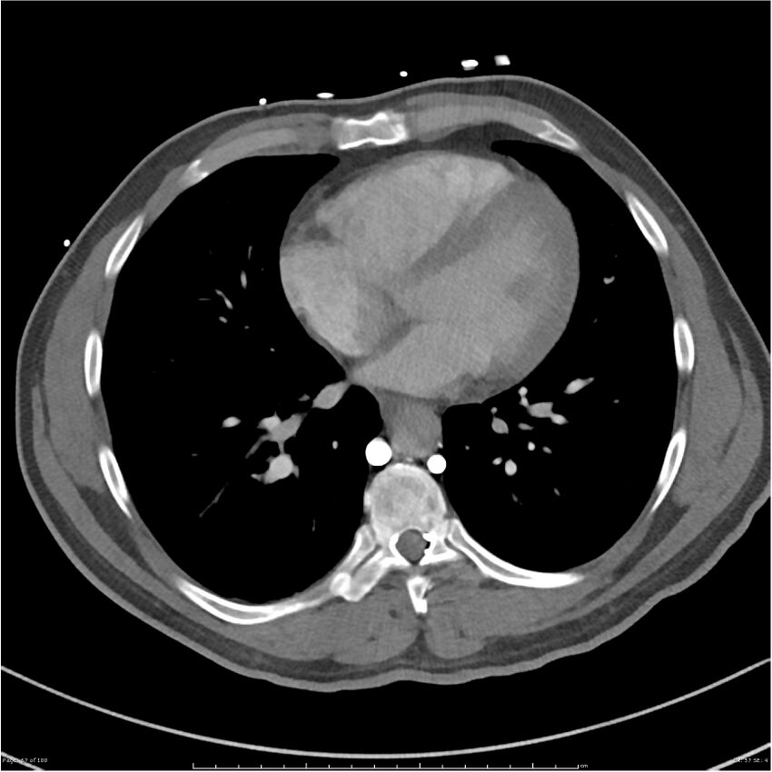 Azygos venous system anatomy (CT pulmonary angiography) (Radiopaedia 25928-26077 Axial C+ CTPA 57).jpg