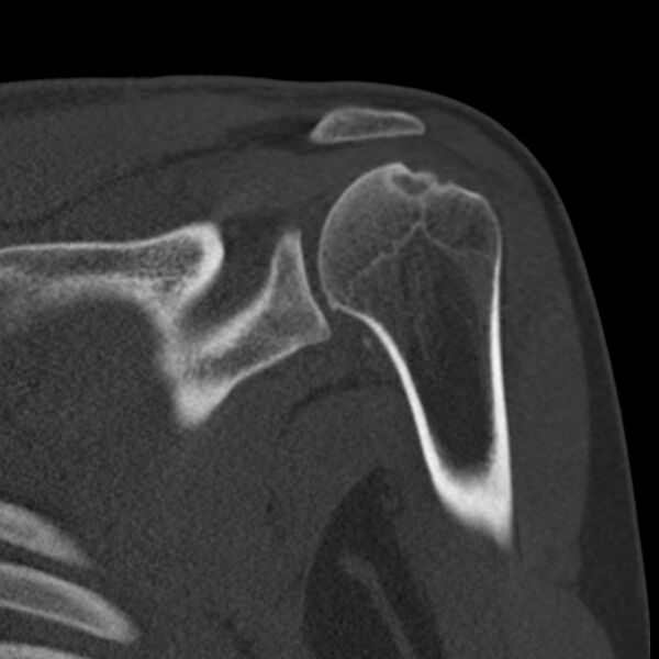 File:Bankart lesion (Radiopaedia 22771-22798 Coronal bone window 25).jpg