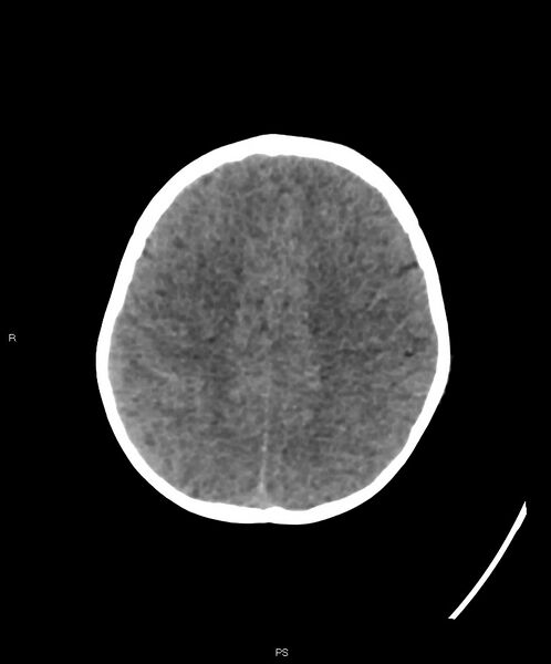 File:Basal ganglia and parenchymal ischemia (Radiopaedia 45818-50083 Axial non-contrast 12).jpg