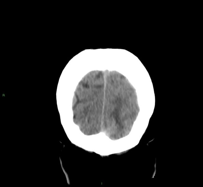 File:Basal ganglia hemorrhage (Radiopaedia 58759-65981 Coronal non-contrast 13).jpg