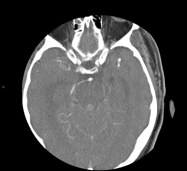 File:Basal ganglia hemorrhage (Radiopaedia 58763-65985 D 73).jpg