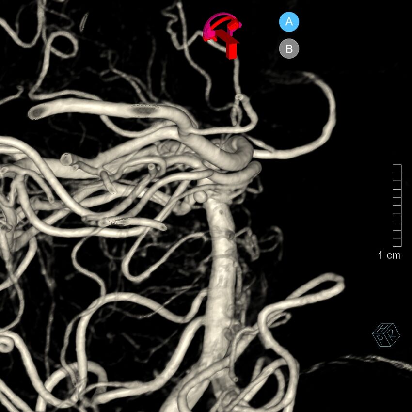 Basilar artery perforator aneurysm (Radiopaedia 82455-97734 3D view left VA 147).jpg