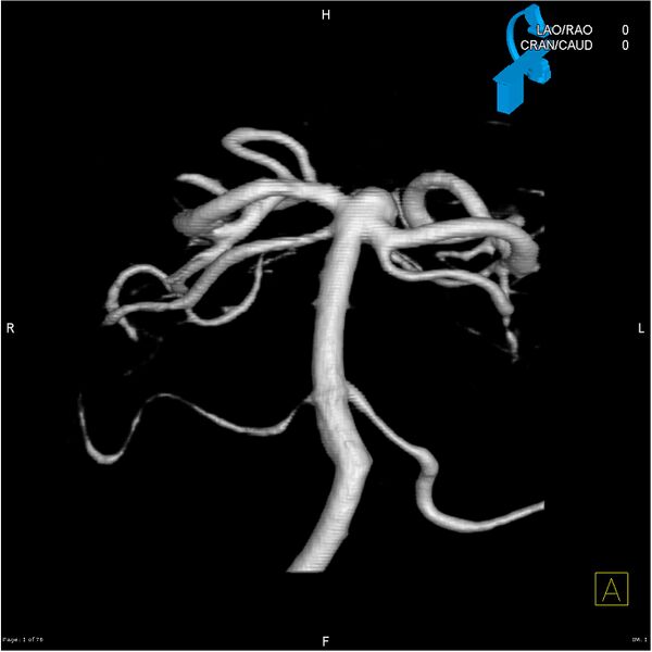 File:Basilar tip aneurysm double balloon remodeling (Radiopaedia 18100-17883 3D rotation 1).jpg