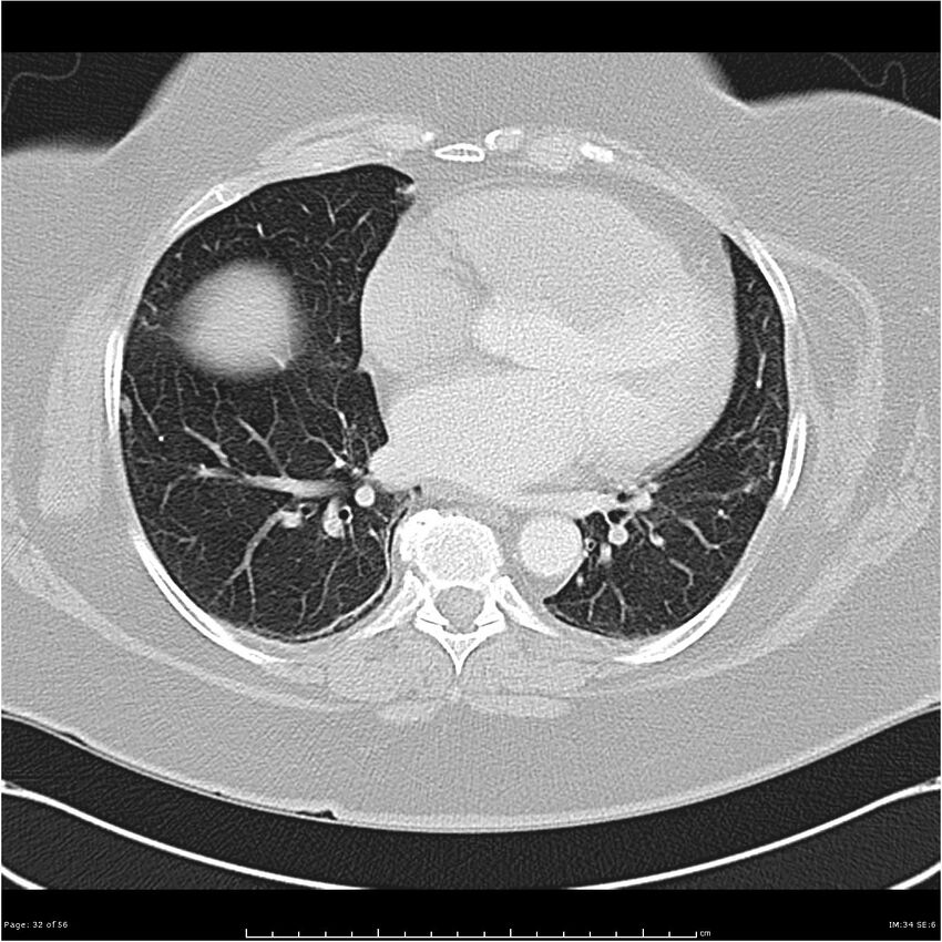 Benign metastasizing leiomyoma (Radiopaedia 26803-26962 Axial lung window 32).jpg