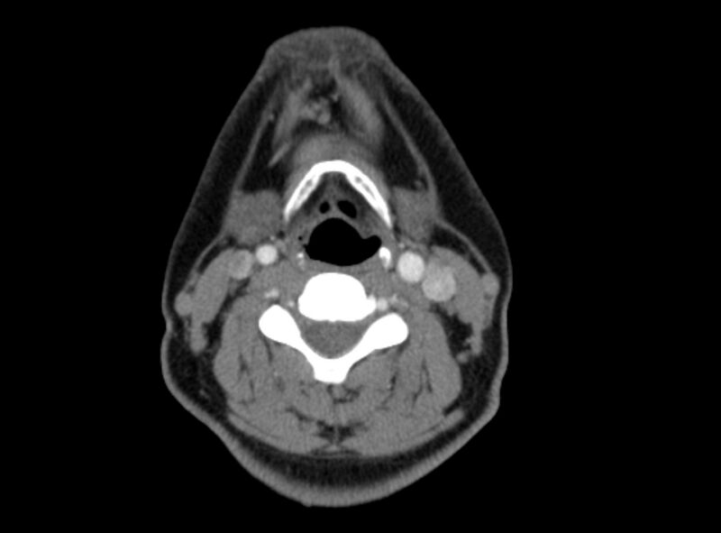 File:Benign mixed salivary tumor of the parotid gland (Radiopaedia 35261-36792 A 30).jpg