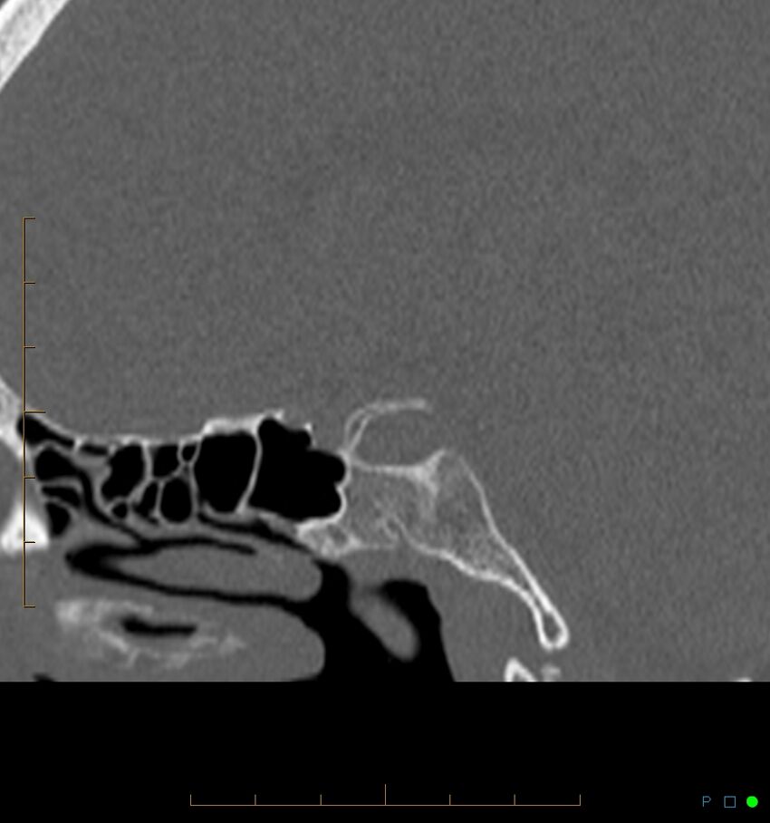Benign notochordal cell tumor (probable) (Radiopaedia 65475-74546 Sagittal bone window 12).jpg