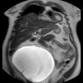 Benign seromucinous cystadenoma of the ovary (Radiopaedia 71065-81300 Coronal T2 17).jpg