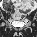 Bicornuate uterus (Radiopaedia 11104-11492 Coronal T2 1).jpg