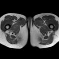 Bicornuate uterus (Radiopaedia 61974-70046 Axial T1 48).jpg