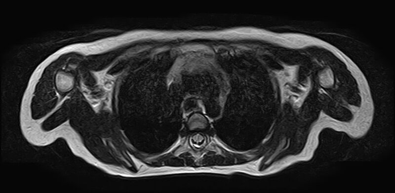 File:Bilateral Sprengel deformity with Klippel-Feil syndrome (Radiopaedia 66395-75650 Axial T2 27).jpg