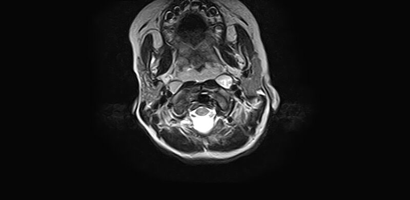 File:Bilateral Sprengel deformity with Klippel-Feil syndrome (Radiopaedia 66395-75650 Axial T2 5).jpg