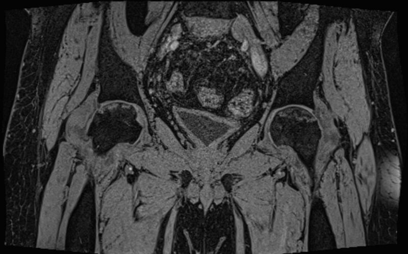 File:Bilateral avascular necrosis of femoral head (Radiopaedia 77116-89078 Coronal T2 we 44).jpg