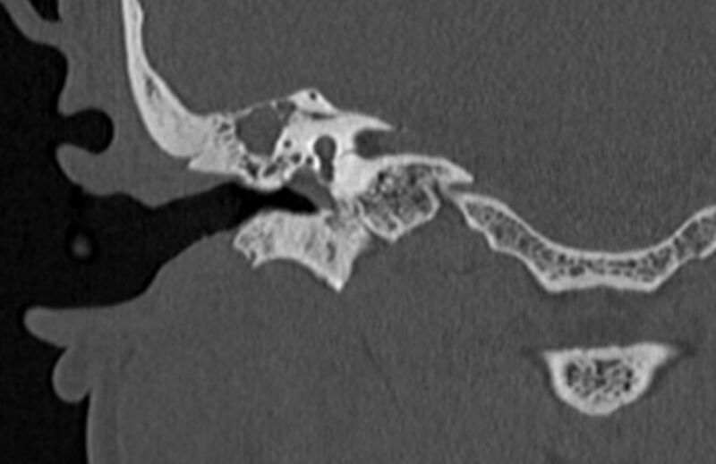 File:Bilateral cholesteatoma (Radiopaedia 54898-61172 Coronal bone window 42).jpg