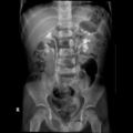 Bilateral duplex kidneys with left-sided uterocoele (Radiopaedia 20811-20725 Frontal 1).jpg