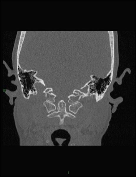 File:Bilateral frontal mucoceles (Radiopaedia 82352-96454 Coronal 332).jpg
