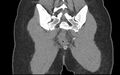 Bilateral mature cystic ovarian teratoma (Radiopaedia 88821-105592 Coronal non-contrast 40).jpg