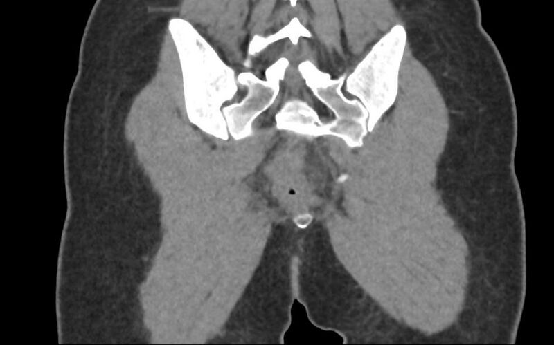 File:Bilateral mature cystic ovarian teratoma (Radiopaedia 88821-105592 Coronal non-contrast 40).jpg