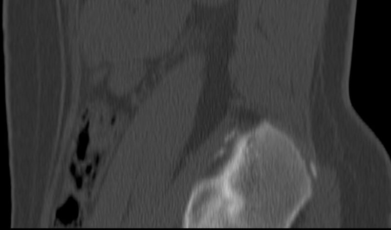 File:Bilateral pars defect (Radiopaedia 26691-26846 Sagittal bone window 4).jpg