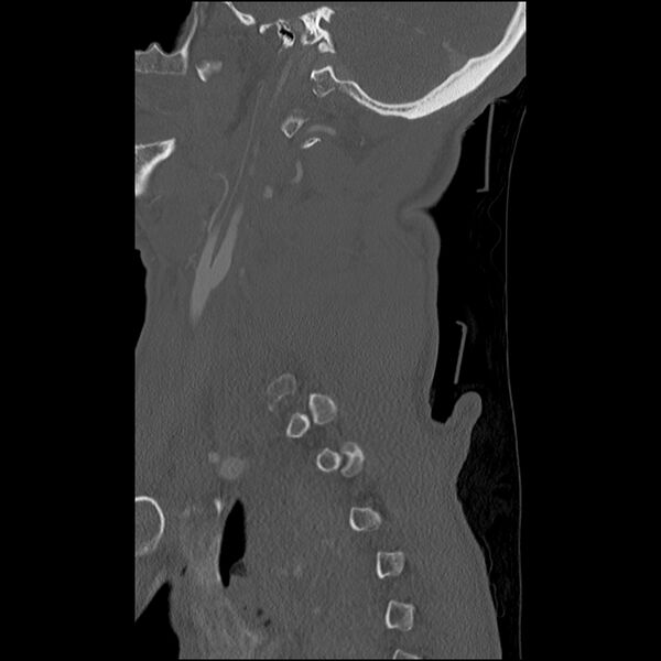File:Bilateral perched facets with cord injury (Radiopaedia 45587-49713 Sagittal bone window 9).jpg